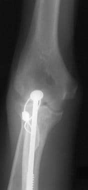 Anteroposterior radiograph following reduction and