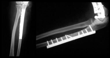 Floating elbow. Combined Monteggia fracture with d