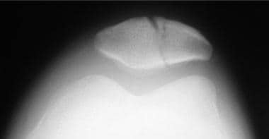 Preoperative sunrise radiograph of patella fractur