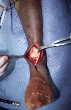 Giant cell tumor. Intraoperative photograph of sam