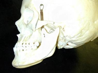 Zygomatic osteotomies are performed at the junctio