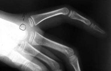 Radiograph of the hand of the patient in Image 6. 