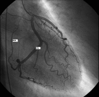 Coronary angiography showing the origin of the rig