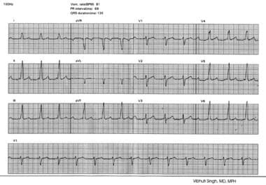 12-lead electrocardiogram showing short PR interva