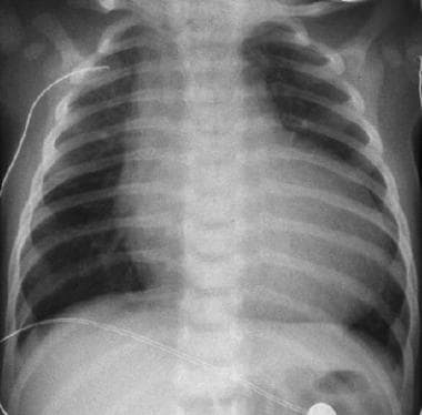 Chest radiograph in a patient with cardiomegaly, w
