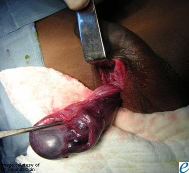 Intravaginal testicular torsion with ischemia in a