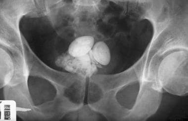 Multiple laminated bladder calculi in patient with