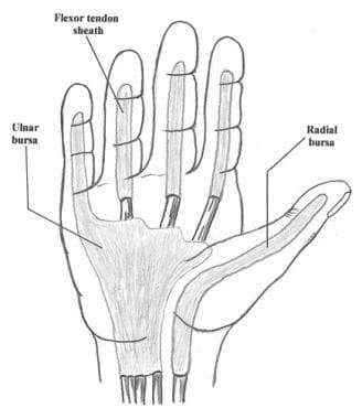 Hand Infection Incision