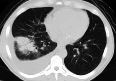 Chest CT scan in a patient with pleuropulmonary no