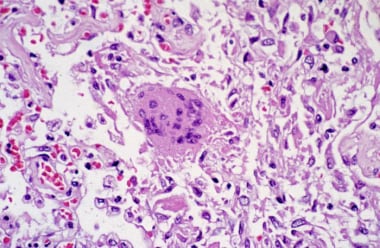 Pathologic slide of pulmonary tissue infected with