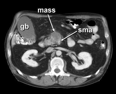 Pancreatic cancer. Computerized tomographic scan s