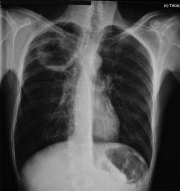 Chest radiograph of a patient who had foul-smellin