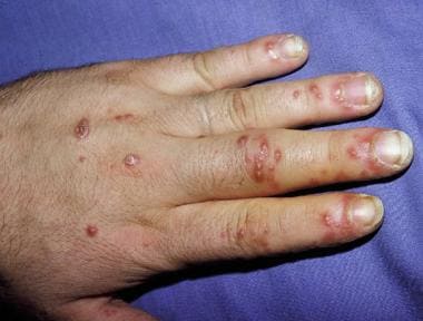Painful erosions on fingers in patient with reacti