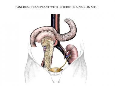 Simultaneous pancreas-kidney transplantation with 