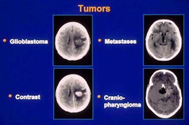 Neoplasms, brain. CT images of several tumor types