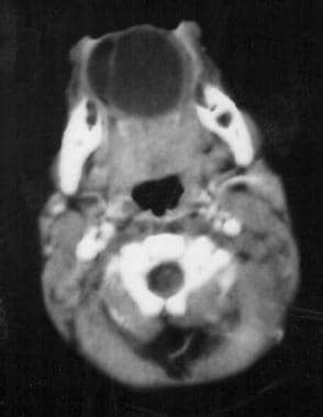 CT scan of ranula. 