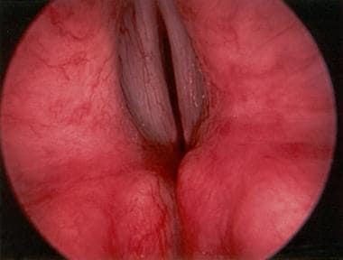 Direct laryngoscopic view of the larynx in a patie