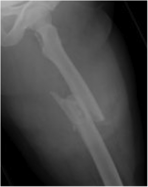 Radiograph of a high-energy femoral shaft fracture