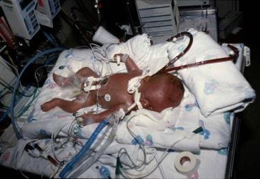 Newborn baby with congenital diaphragmatic hernia 