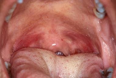 The soft palate is not usually keratinized and is 