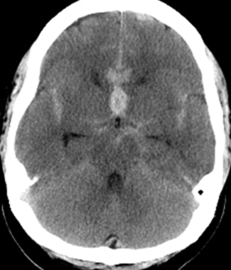 Follow-up head CT scan showing subarachnoid blood.