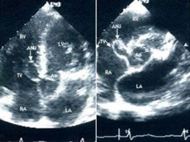 Sinus of Valsalva aneurysm. Apical four chamber (l
