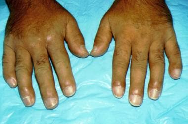 Scleroderma affecting the hands. Note the taut app