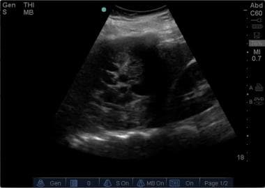 Ultrasound image of a loculated pleural effusion. 