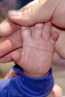 A palmar, simian crease in a patient with Down syn