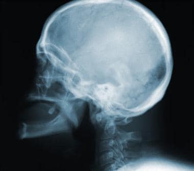 Routine lateral cervical radiograph of a 28-year-o