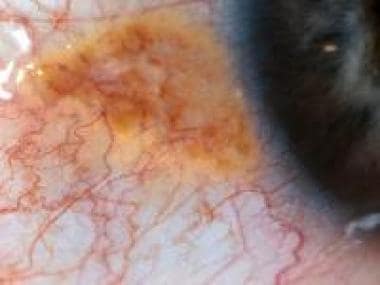 Conjunctival nevus. Courtesy of Peter Rubin, MD, D