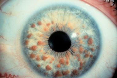 Ophthalmologic Manifestations Of Neurofibromatosis Type 1 NF 1 