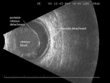 B-scan image of the same traumatic vitreous hemorr
