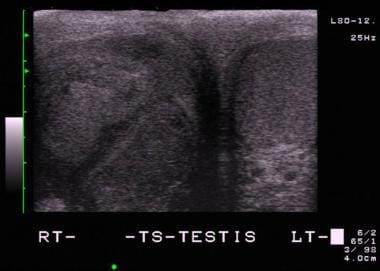 Bilateral view of the testes across the median rap