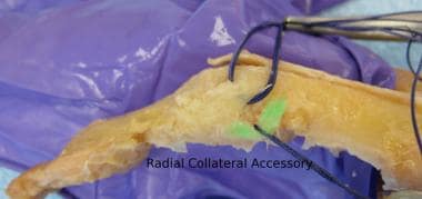 The collateral accessory ligament. 
