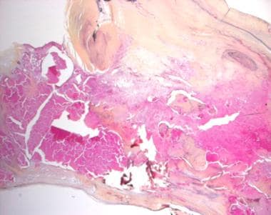 Aortic Stenosis Pathology. Histologic section of t