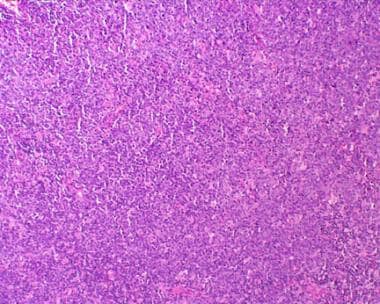Diffuse lymphoma. Note the absence of the nodular 