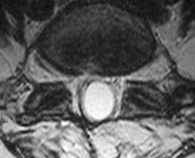 Axial T2-weighted MRI of the lumbar spine obtained