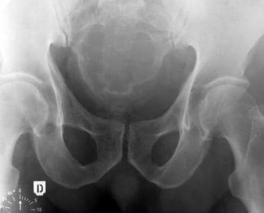 Sacrococcygeal chordoma. Plain radiograph of the p