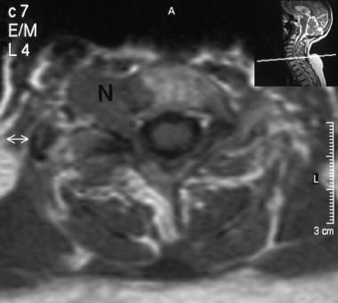 A 66-year-old woman with NF1 presented with parest