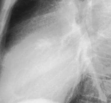 Lateral chest radiograph demonstrating thick calci