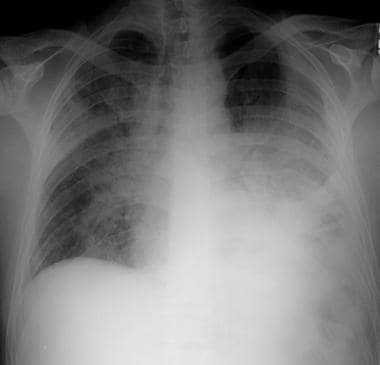 Posteroanterior (PA) chest radiograph of a man in 