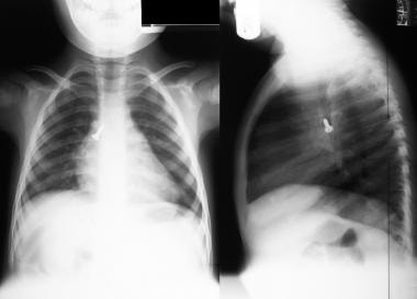 Chest radiograph in a child shows an inhaled metal