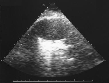 Mediastinal sonogram obtained through the right pa
