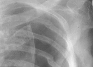 infant pneumothorax x ray