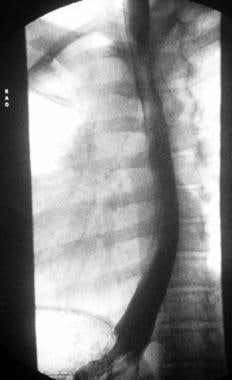 Gastroesophageal reflux at the level of the thorac