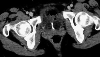 Early cross-sectional CT scan shows a right ureter