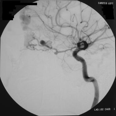 Angiogram in a patient with a frontal dural fistul
