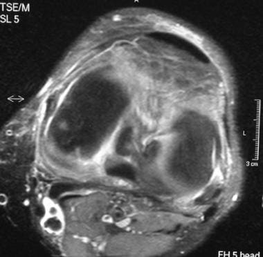 Axial, T2-weighted magnetic resonance image with f