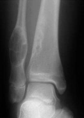 Anteroposterior radiograph of the distal tibia and